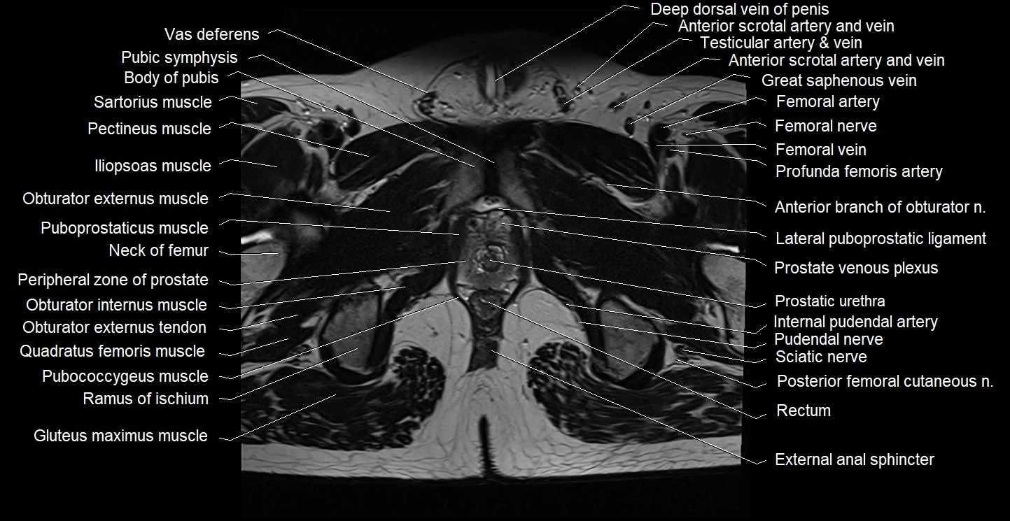 Male pelvis axial cross sectional anatomy image 37.webp